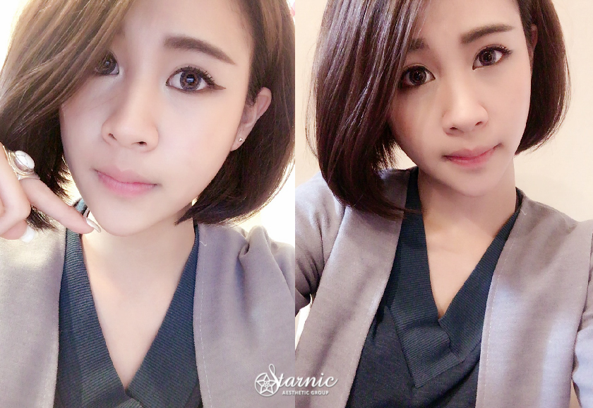 【玻尿酸補下巴】 星和診所/高雄醫美-視覺效果立馬-5KG看起來立刻消瘦5公斤的完美(上)-Crystal