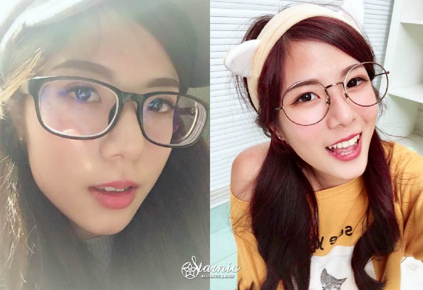 【瘦小臉注射】星和診所/台南醫美-鄭玉貞醫師—我的瘦小臉初體驗—方唯貞Chubby (上)