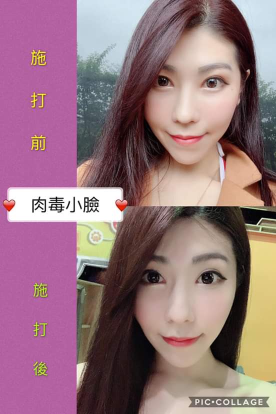 【肉毒桿菌】美麗不等人，現在不保養以後你一定會後悔！ 第一步總是難踏出我懂！！！！～-丁法法