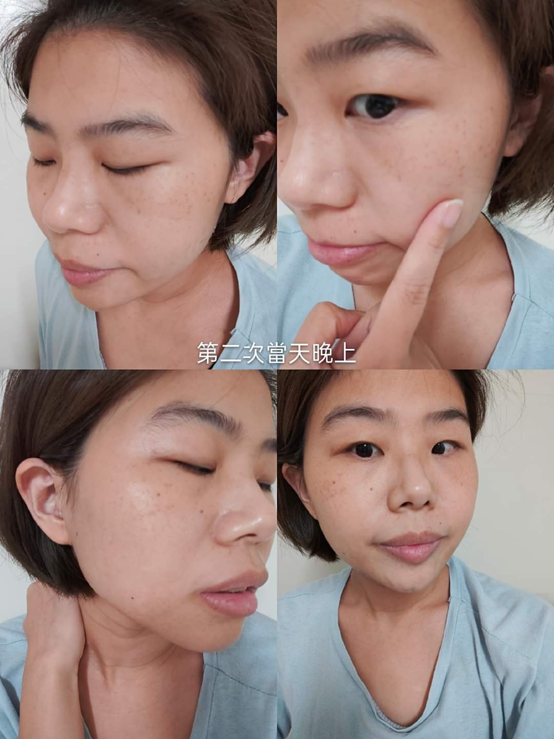 【皮秒雷射】星和診所-台中市 陳璟毅醫師-連老公都說有變透亮_Yoki 生活雜誌