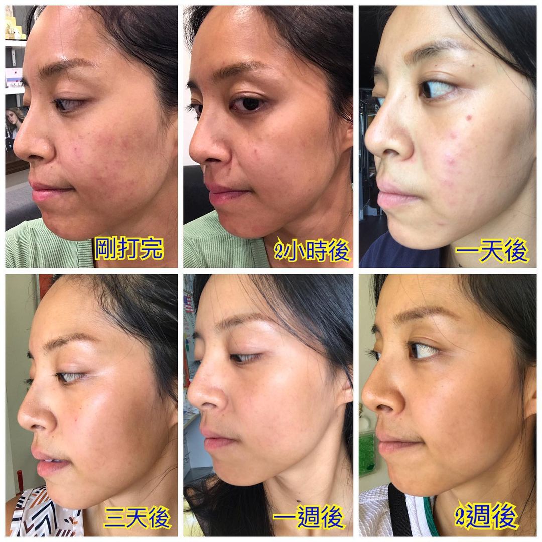 【皮秒雷射】星和診所（新竹市） 薛博今醫師-女人想要有健康又亮麗的肌膚就得勤勞起來_素食舉重女孩wanda