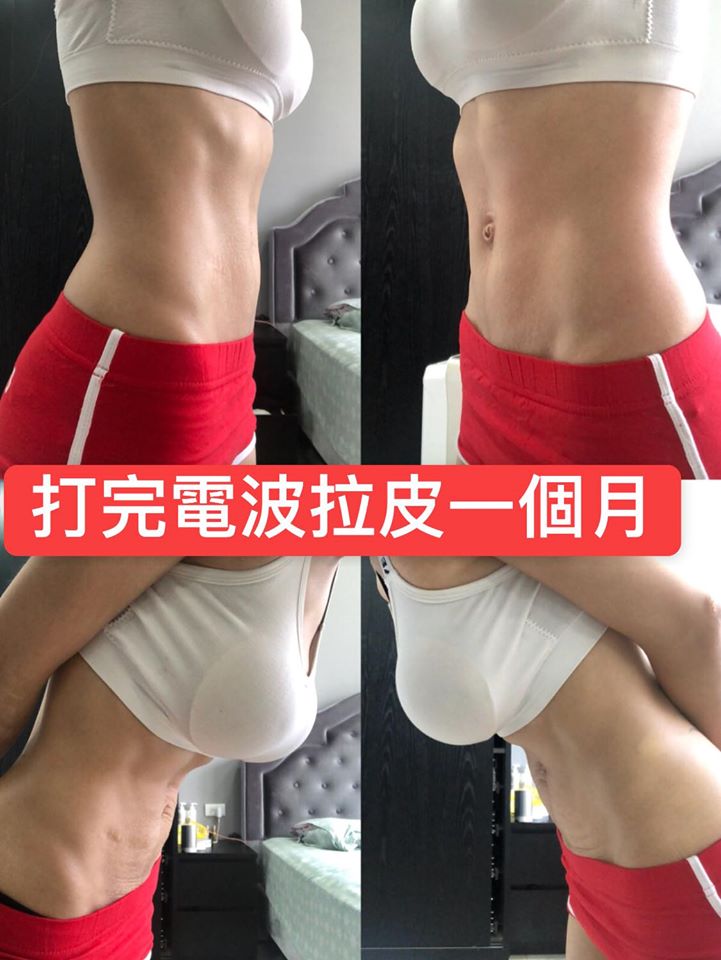 【電波拉提】星和診所/台中醫美-非侵入拉提，趕走像沙皮狗的醜醜肚皮-布小丁(下)