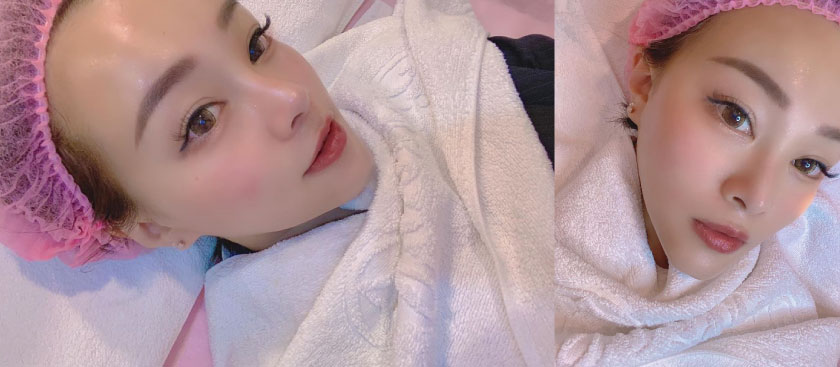 【杏仁酸煥膚】星和診所（新竹）-還我透亮的肌膚-蛋娘、彭妍妍(下)