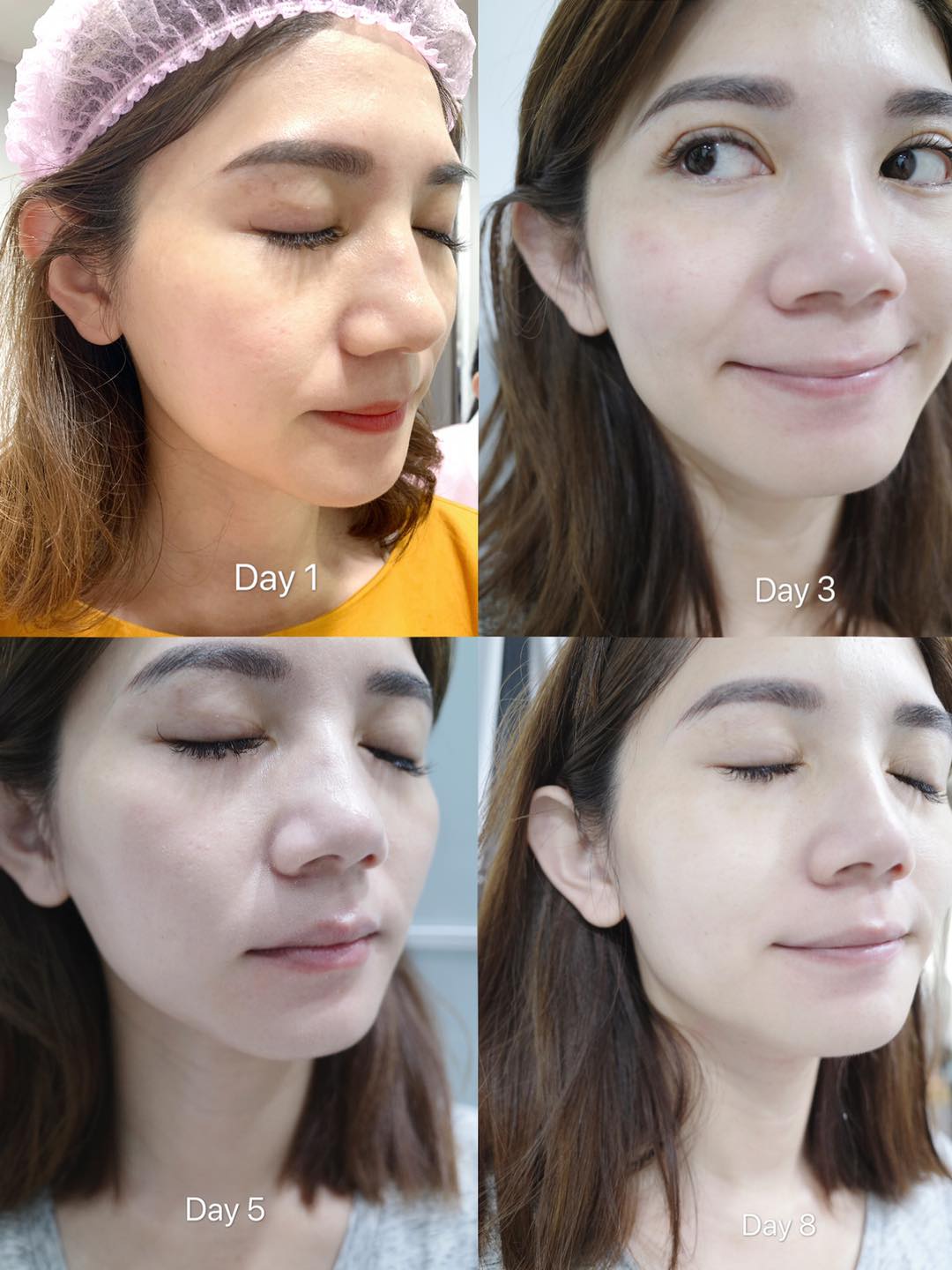 【皮秒雷射】台北星和診所-這是我今年皮膚最好的狀態吧_HERE 安九