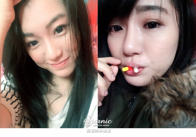 【櫻花/染料雷射+淨膚雷射】星采整形外科診所(大安)-一次雙機解決暗沉與紅痘疤！(下)