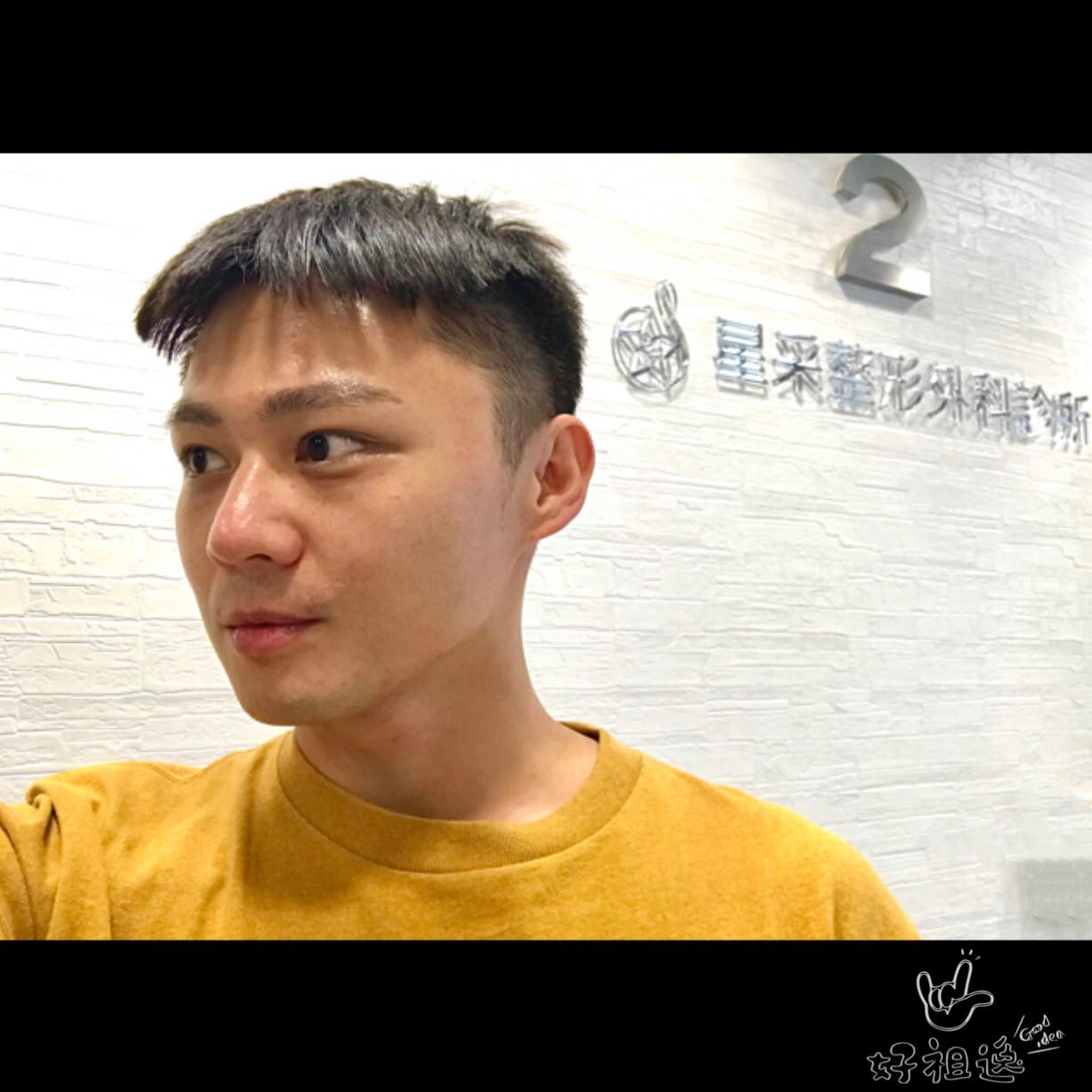  【杏仁酸】星采整形外科診所-一定要定期的來保養一下-佘祖逸TzuYi SHE