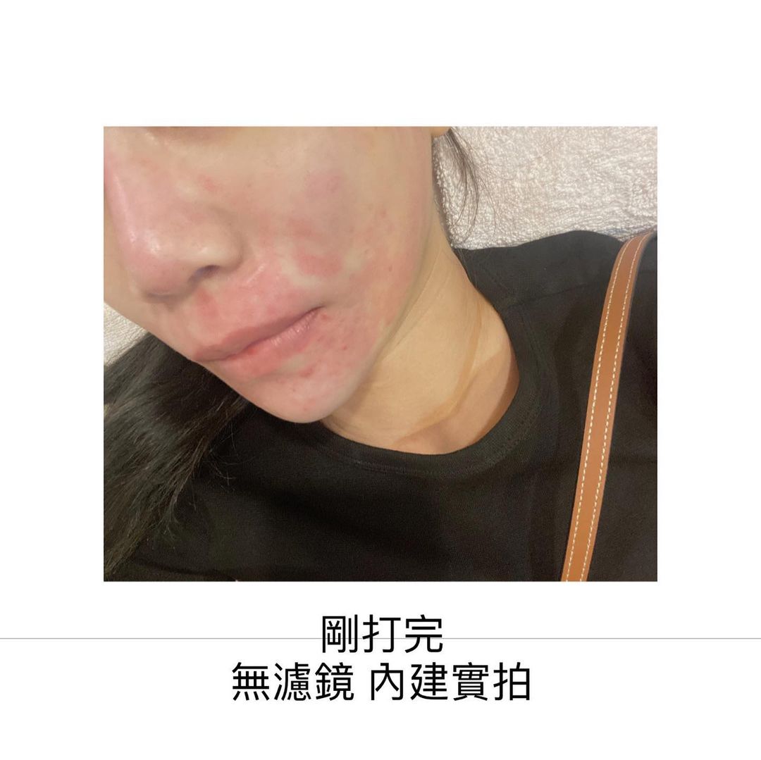 【皮秒雷射】星和醫美診所竹北店-靠皮秒來收痘疤的三魂七魄!_Ricole小雞