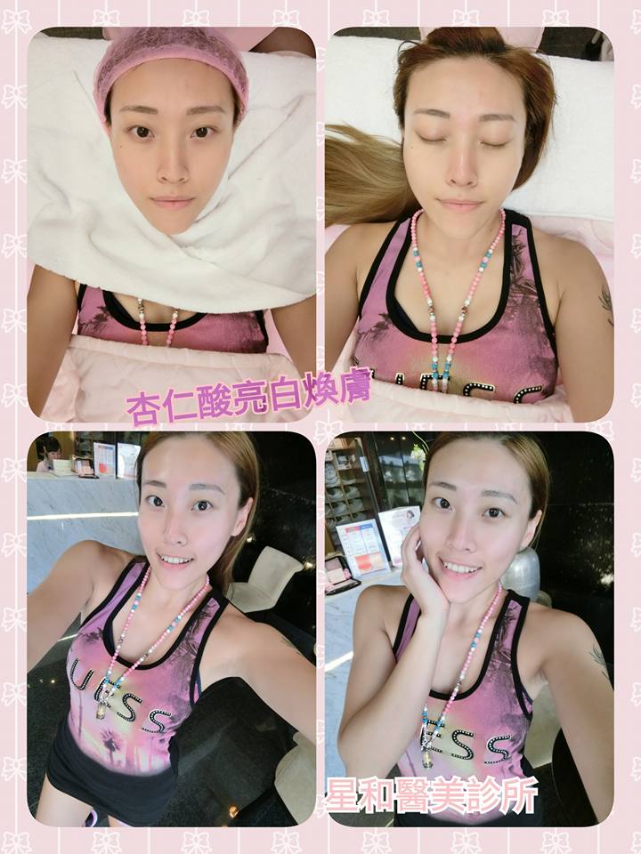 【杏仁酸】星和診所/台中醫美-“杏仁酸煥膚”讓妳容光煥發 ！-Angel Yang