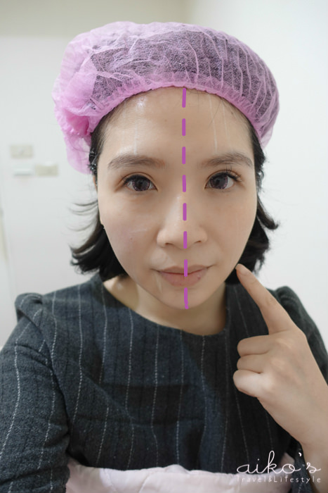 【Ultherapy優珊納超音波治療儀(極線音波拉提)】-星和診所（新竹市）-陳璇醫師-女孩愛自己必備的Ultherapy極線音波拉提-Aiko (下)