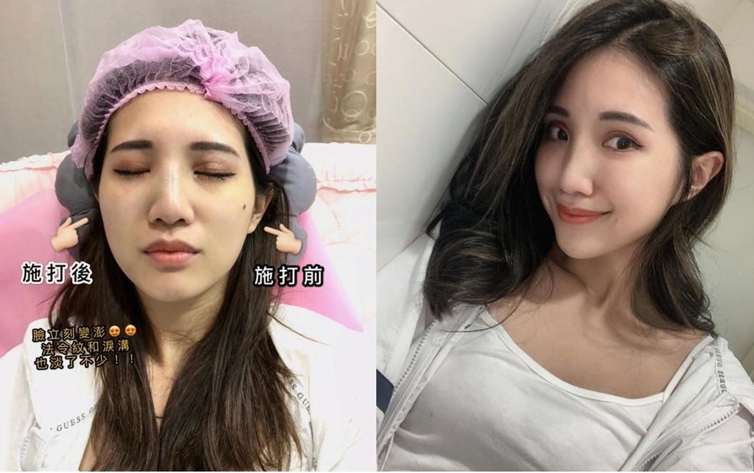 【玻尿酸】星和診所（新竹市）-掩護小小的變美痕跡！口罩下的美麗也要超前部屬-林明潔醫師-Betty
