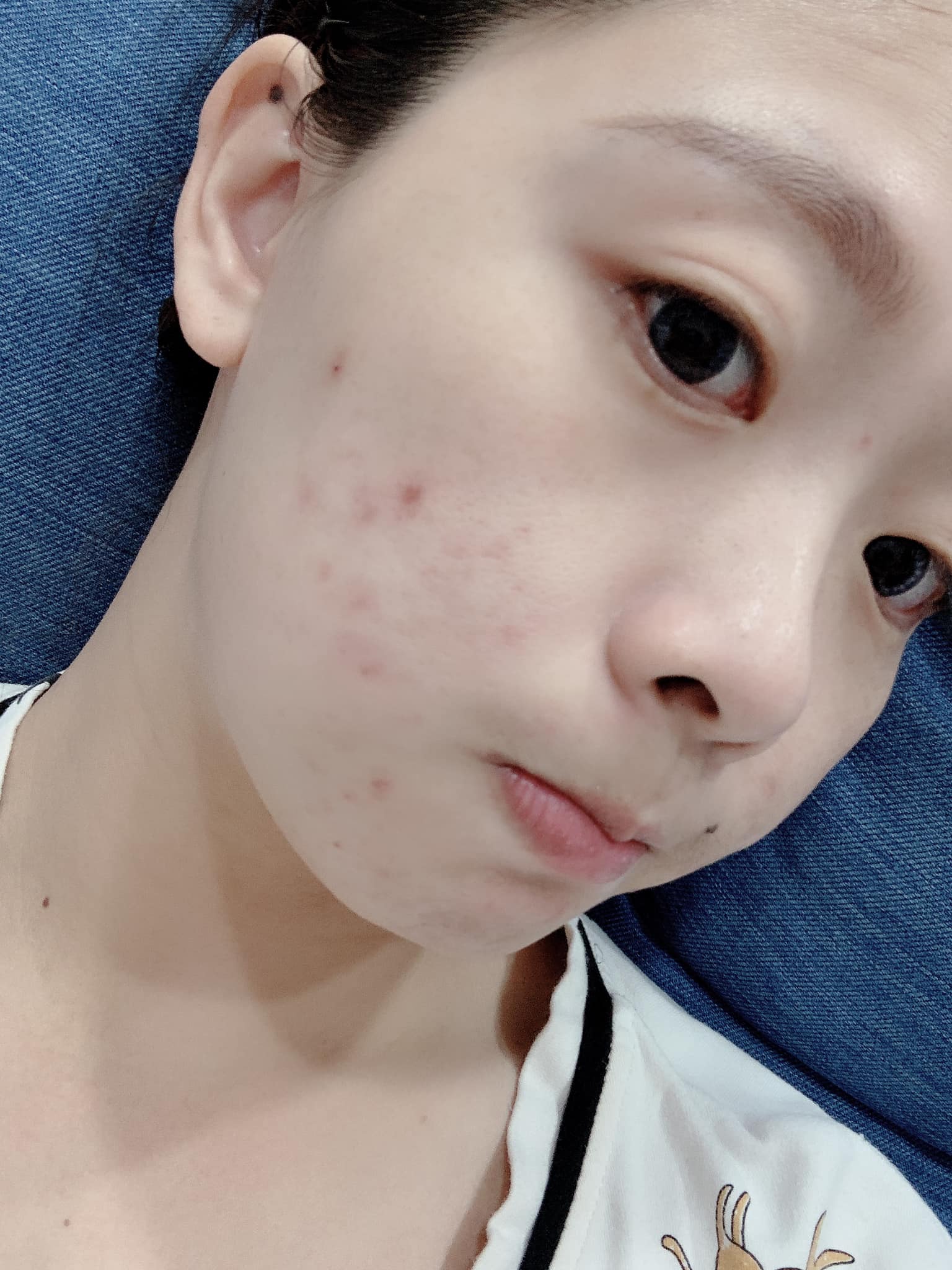 【杏仁酸】星和診所/高雄醫美-為了讓臉早日乾淨這些痛只能忍啊-Cali 卡卡