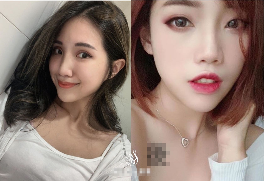 【玻尿酸】
