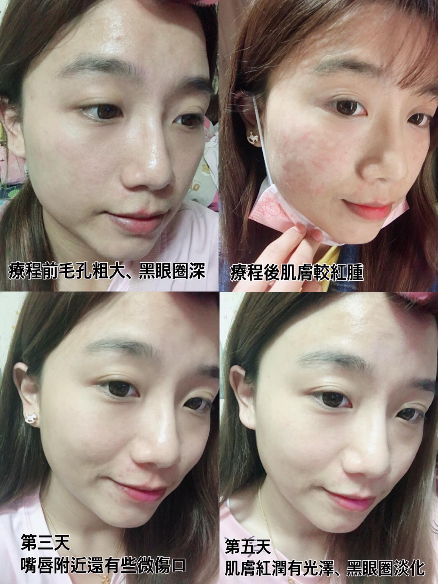 【水光針】星和診所/台中醫美-顏崇文醫師-女生就是要多愛自己一點 快跟我一起變美❤️-沈虹慧