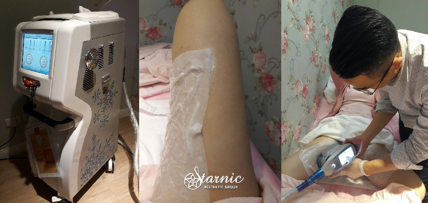 【冷凍減脂】星采皮膚專科診所(古亭)＿大腿肉終於不會再黏一起了！！＿萱萱(下)