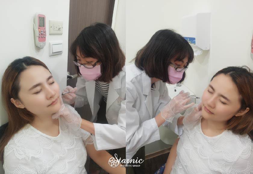 【天使瘦小臉注射】星和診所（新竹）-陳璇醫師-女人就該好好經營自己－從消滅咀嚼肌開始-歐妮 (中)