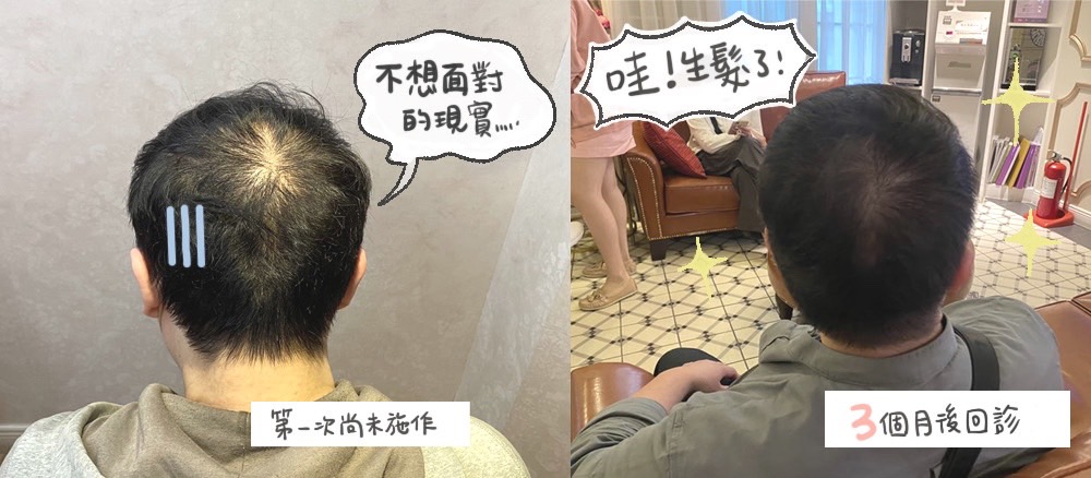 【複合式生髮】星采診所/古亭醫美-把我的頭髮還回來！-泡菜公主的粉絲塗鴉團