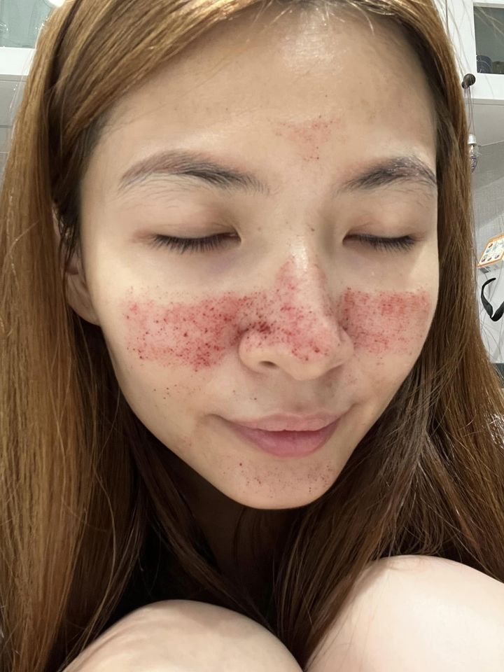 ，【皮秒雷射】