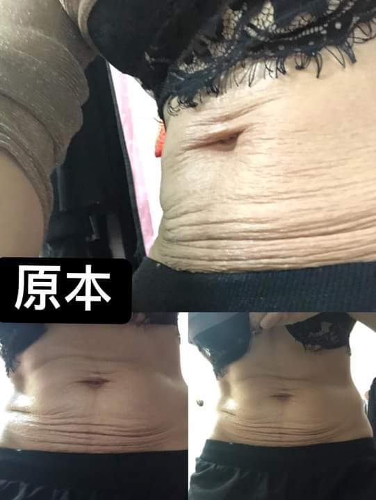 【電波拉皮】穿緊一點的褲子肚子也不會被擠到皺皺的，打完一個月真的有差！！！～-布小丁
