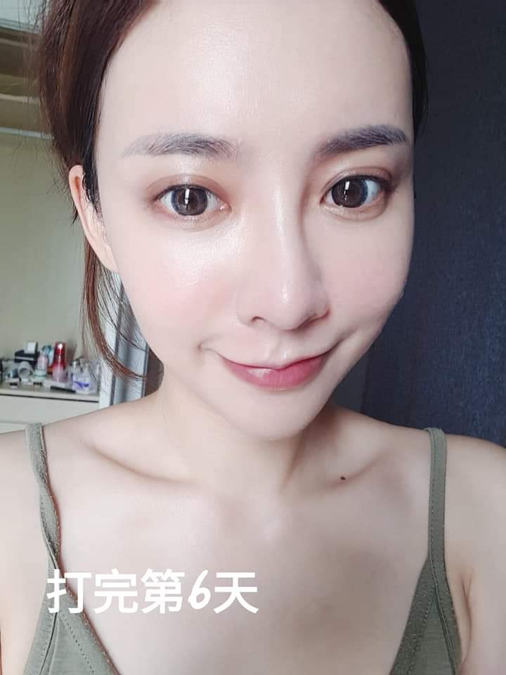  【皮秒雷射】星和診所/台南醫美-鄭玉貞醫師-怕痛的人都可以體驗的雷射-MISS MO