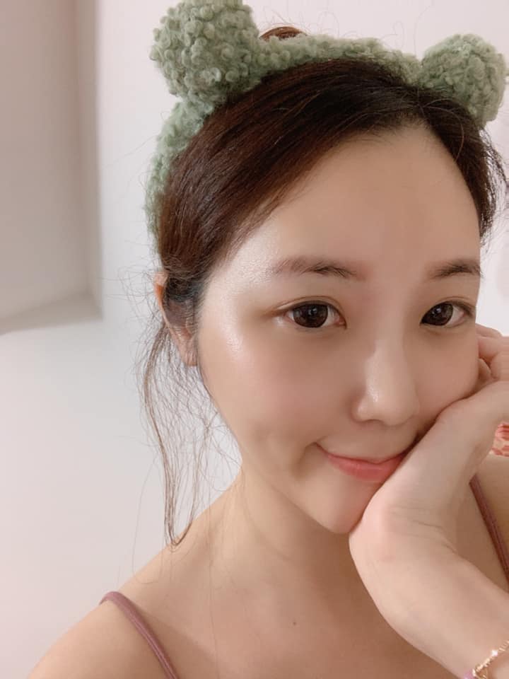 1【杏仁酸煥膚】星和診所/高雄店-粉刺清的乾淨又不用擔心留下疤痕-Sweet Corrine