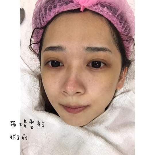 【飛梭雷射】 為什麼那麼愛打雷射呢因為真的很有感啊每次打完結痂掉了都會覺得自己臉亮了！！～-黃悄悄