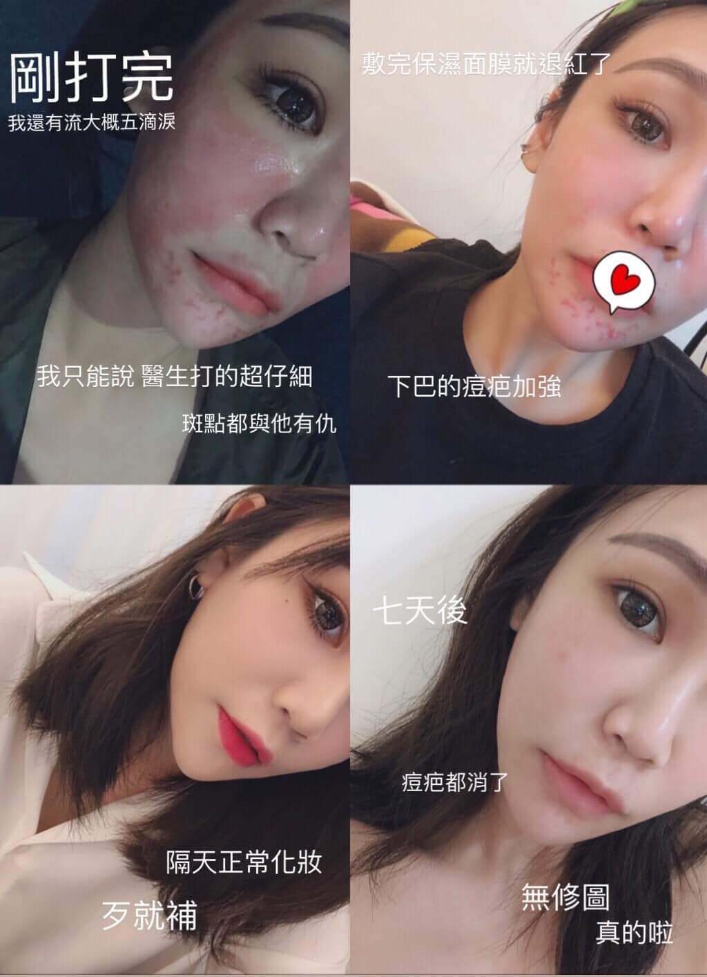 【皮秒雷射】星和診所/竹北自強醫美-王善民醫師-拯救我的斑點殺手-Ricole Ho