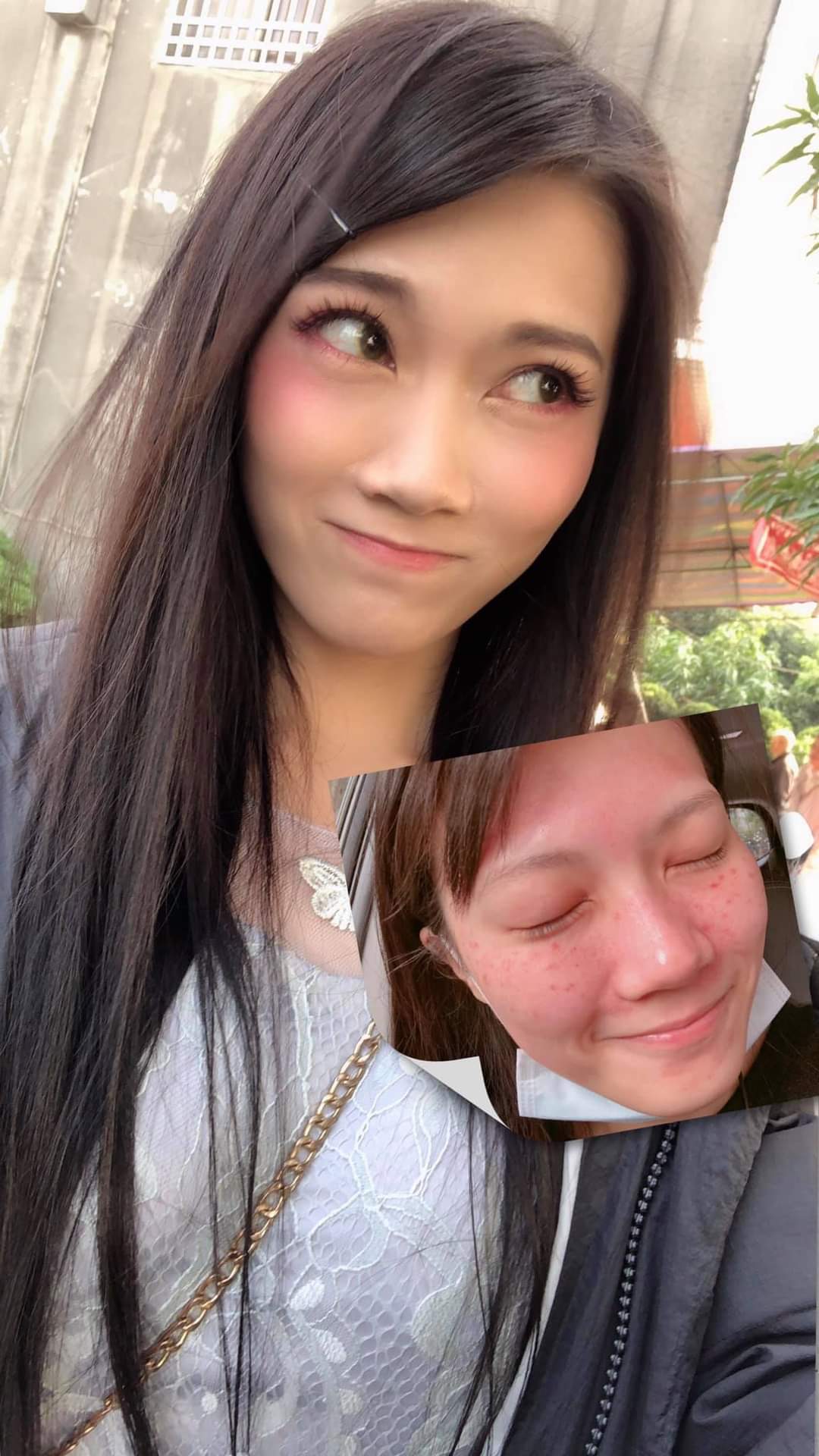  【皮秒雷射】仁愛星和診所/東區醫美-美美上陣當伴娘 -貞貞 