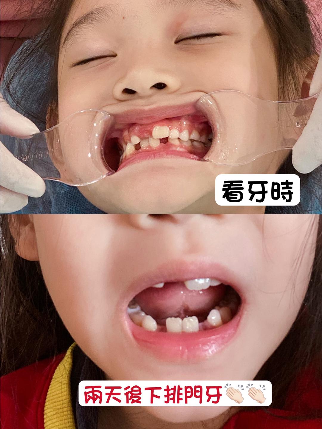 【MRC兒童矯正】星采牙醫-張筑媁醫師-為了孩子健康的口齒成長-楊皓如