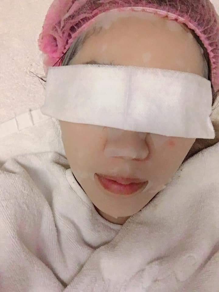 【杏仁酸煥膚】 藻針真的效果很棒很明顯推薦大家一定要來試看看 ▸海藻煥膚❤❤ ~-HuHu 林尹柔