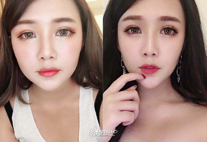 【瘦小臉注射】星和診所/台中醫美-讓網美丟掉修容筆的小秘密-劉yuyu (上)
