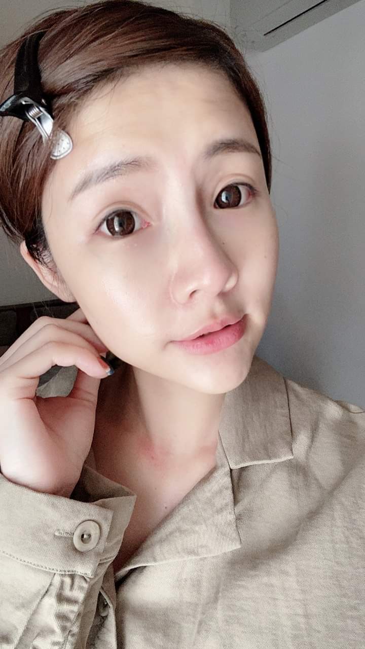 【晶亮瓷】施打晶亮瓷，下定決心「拯救我的短下巴！」~ - 跟蓓蓓一起變美麗
