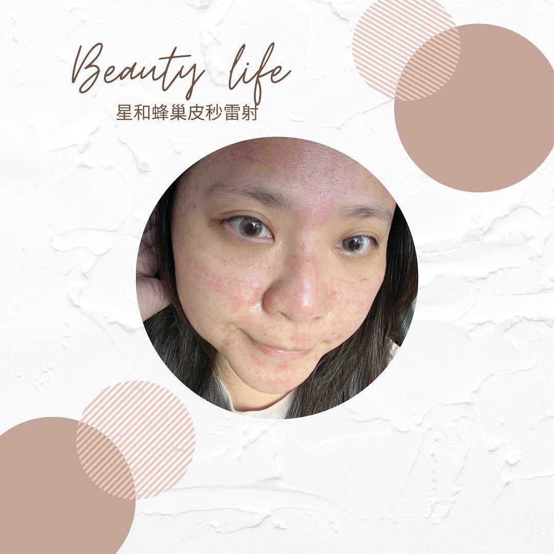 【皮秒雷射】星和診所/仁愛醫美-保養也是快奔4的我很在乎的！-Selene親子生活❤️