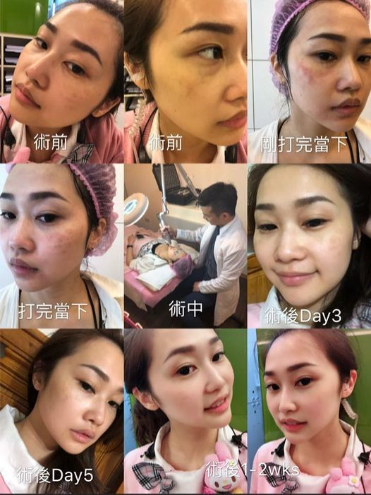 【皮秒雷射】現在醫美最夯的是什麼？讓姐來告訴妳~就是：「皮秒雷射」