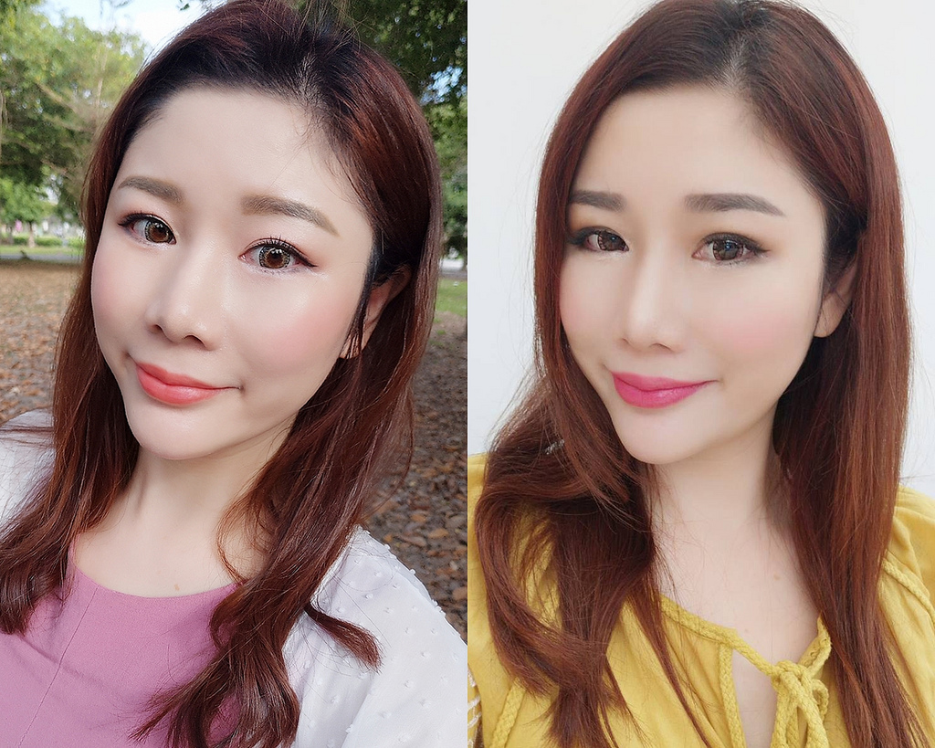 電波拉皮+瘦小臉注射+玻尿酸