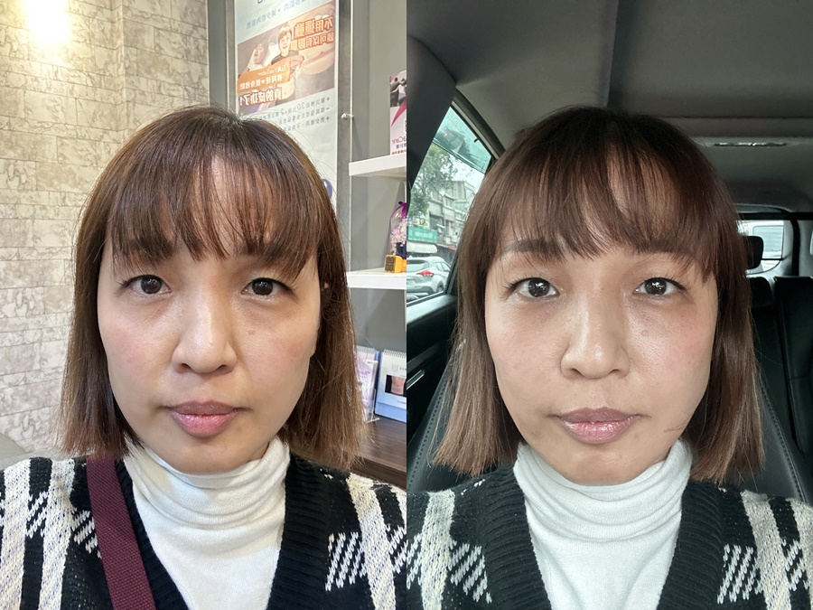 【玻尿酸】星和診所（新竹市）-薛博今醫師-拒絕疲憊老臉 大家和孫仙一起變美吧-dannis & amy - 魯蛋妹&大腸弟吃喝玩樂過生活