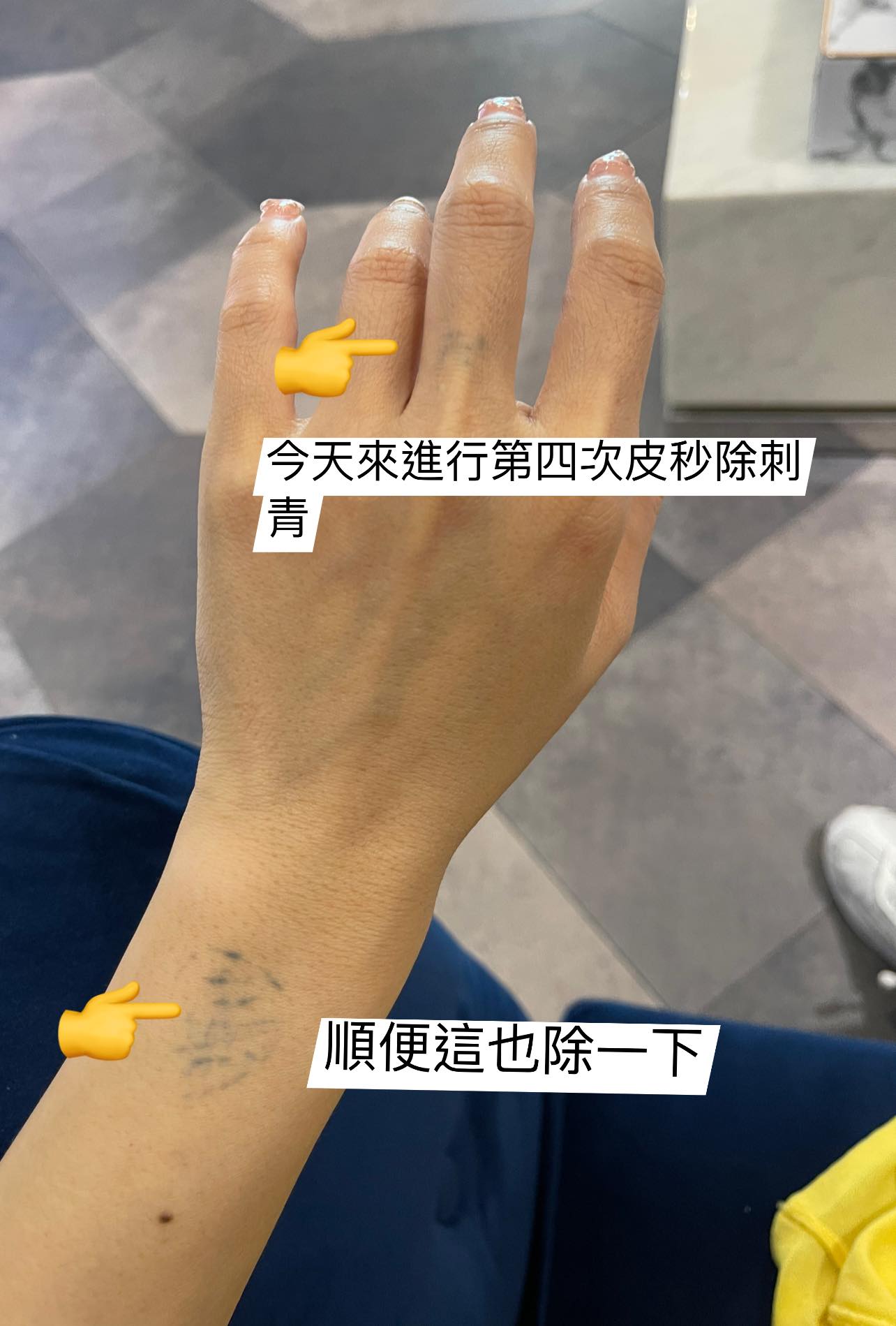 【皮秒雷射】自強星和診所（竹北）-妳是不是也有跟我一樣惱人洗不乾淨的胎記,快來諮詢星和吧-陳小丸