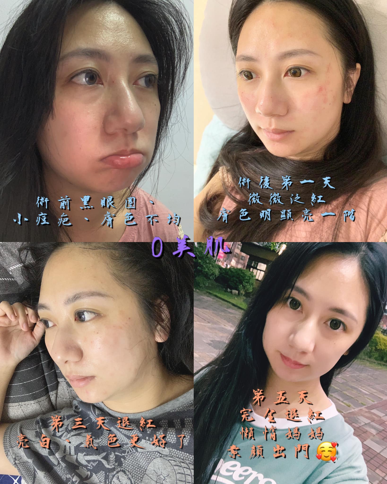 【皮秒雷射】星和診所/仁愛醫美_洗臉的時候甚至可以感受到皮膚變得光滑細緻！-珮珮