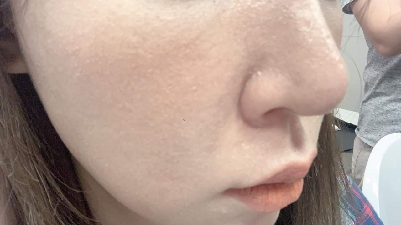 【飛梭雷射 】本來的凹疤跟脫皮，還有不吃妝，ㄧ個禮拜後妝效大家都驚艷無比，每次打完真的都讓我太開心！！！！～-Misa小羽