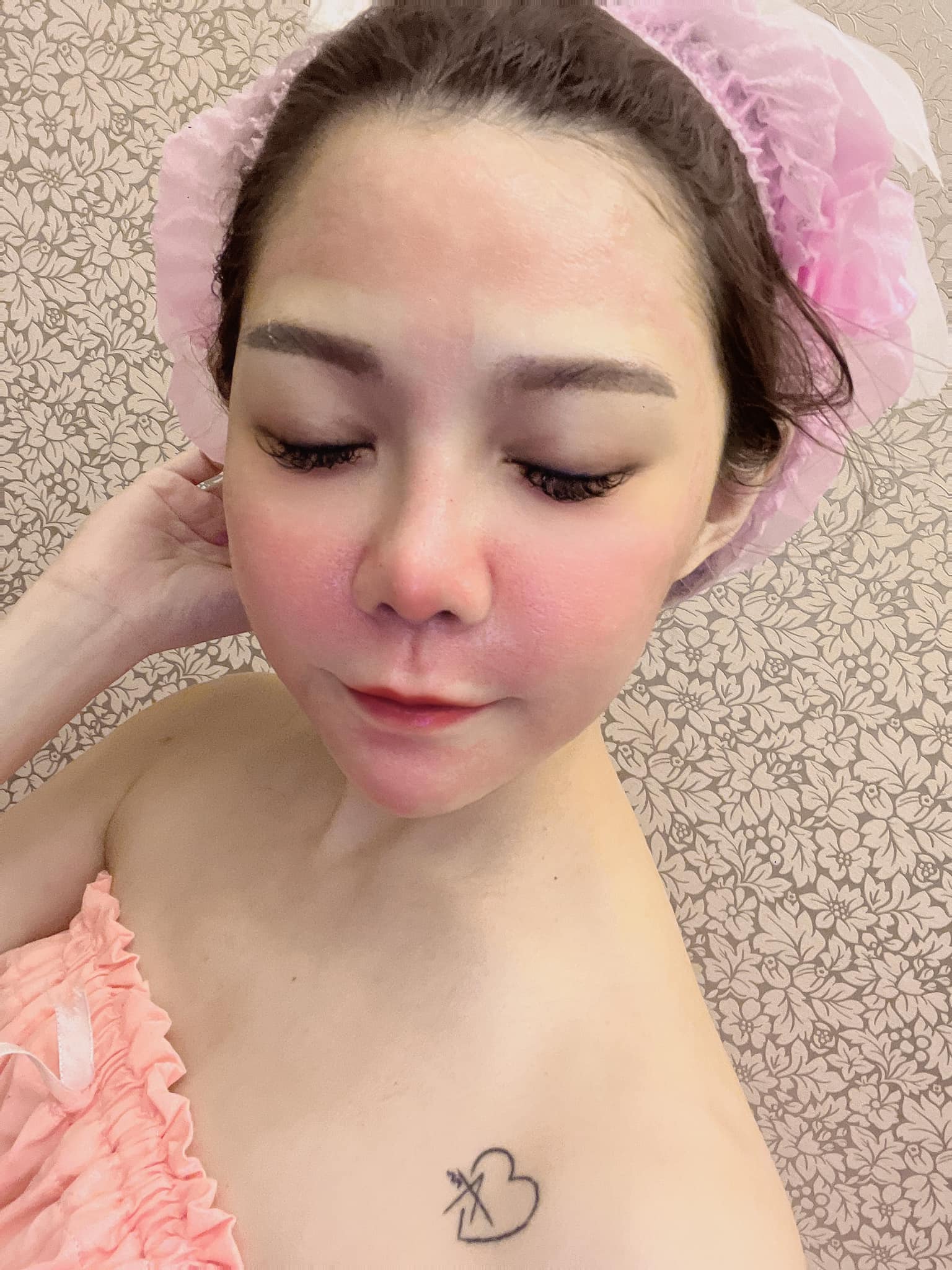 【皮秒雷射】