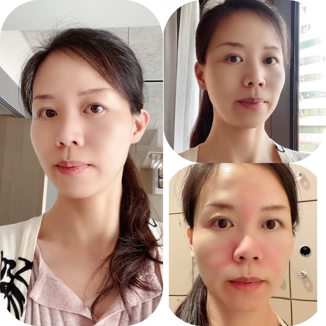  【皮秒雷射】星采整形外科診所/大安醫美-武洵白醫師-經由定期皮秒保養來改善我的毛孔粗大及一些曬斑-Cinya的私房烘焙課