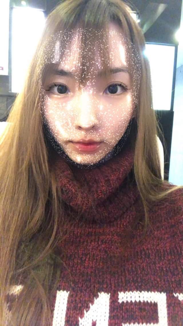 【飛梭雷射】 趁夏天還沒來 還不容易反黑時趕快做一下療程！！～-佳蕙的生活日記