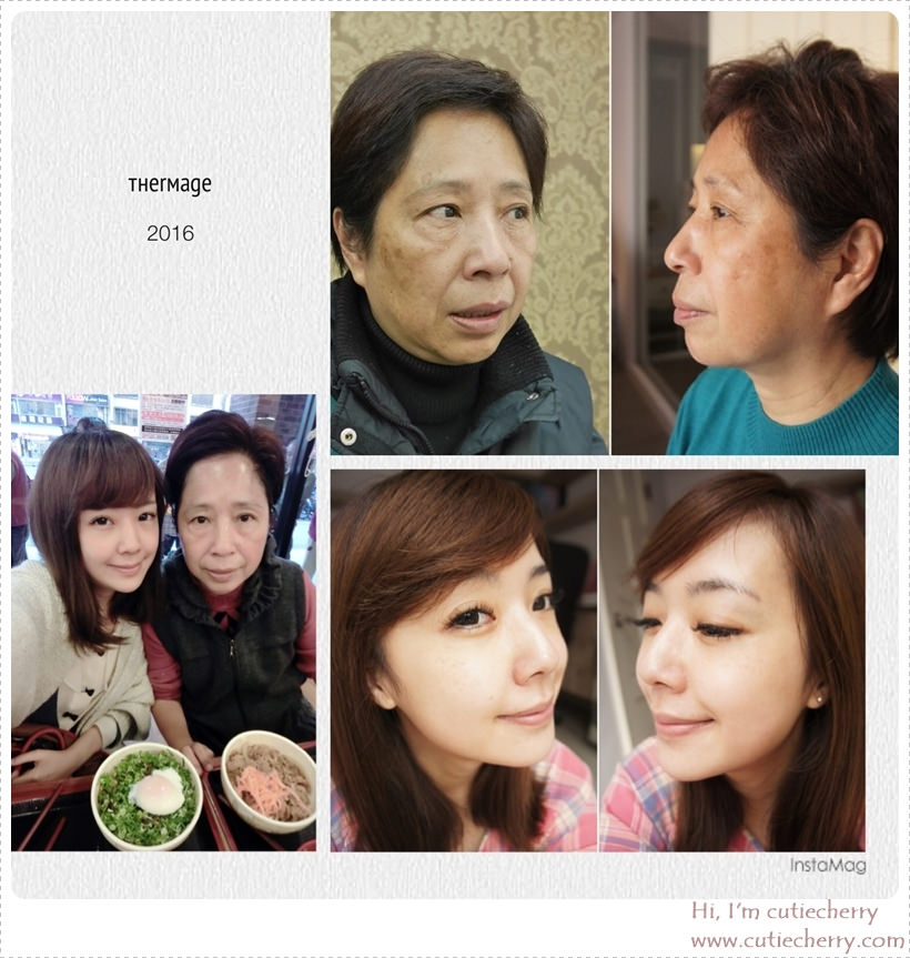 【電波拉皮】星采皮膚專科診所(古亭)- Love U 媽咪，希望妳一年比一年更年輕-全效電波拉皮_翠蕊(上)
