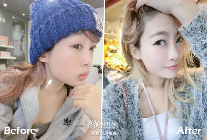 【瘦小臉注射】星和診所（新竹） 陳明如醫師-追求完美無極限之我要當零死角女神~ (上)