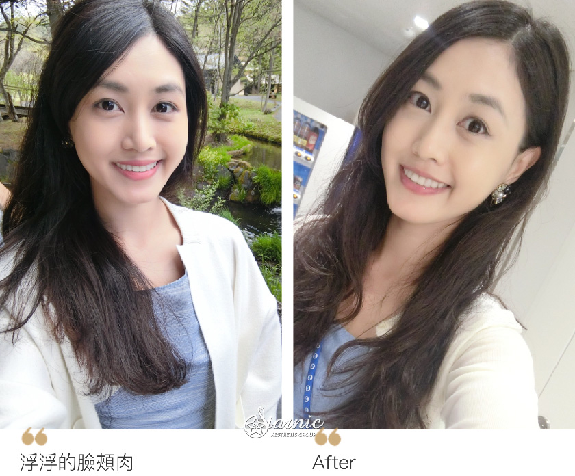 【電波拉皮+音波拉提】星采整形外科診所(大安)-還我少女般的澎潤水嫩肌！-郭惠妮