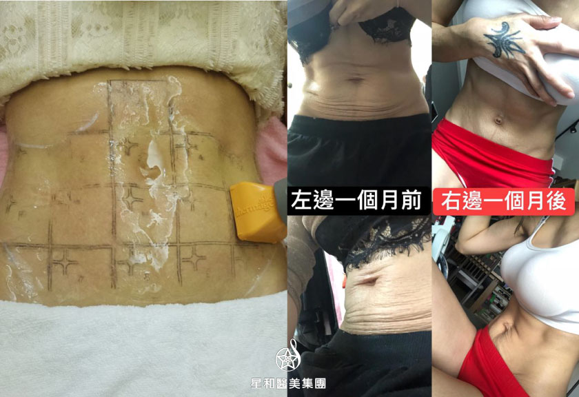 【電波拉提】星和診所/台中醫美-非侵入拉提，趕走像沙皮狗的醜醜肚皮-布小丁(上)
