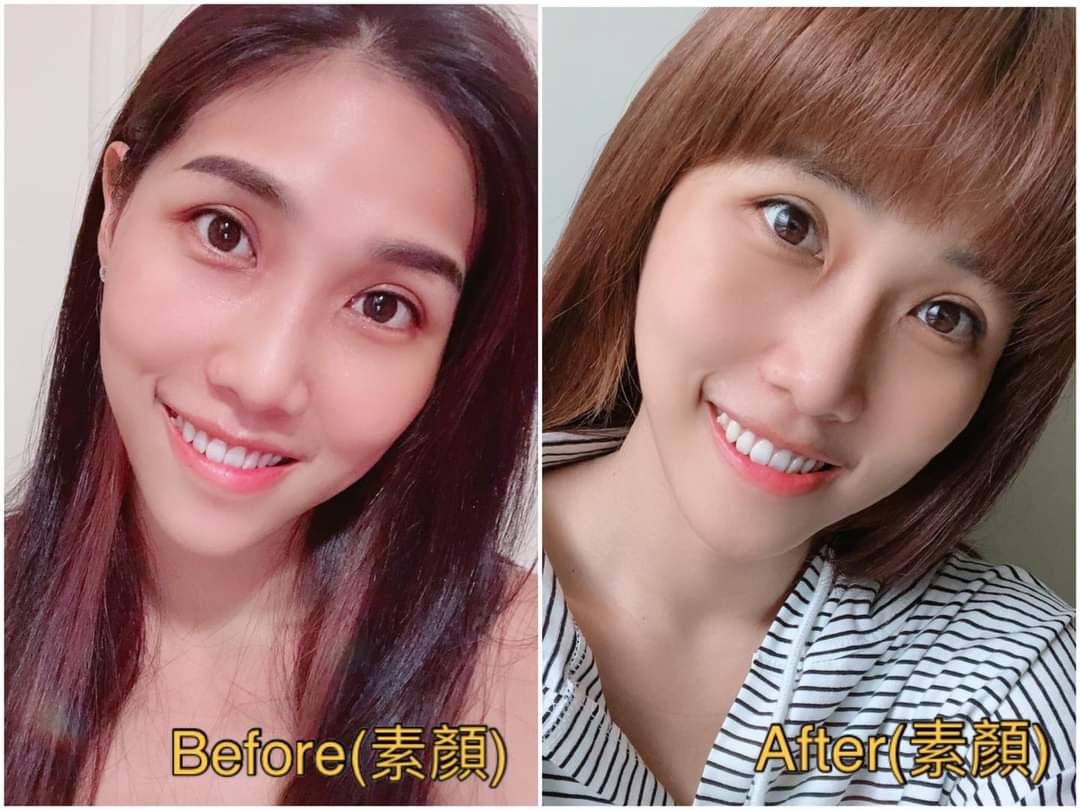 【玻尿酸】施打完後也沒有疼痛感及不舒服～ 接著就給大家看看術前術後的對比照囉!!!~ - 慕霏Mufi