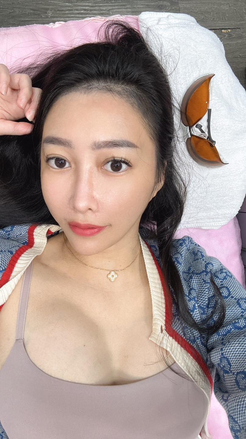 淨膚雷射