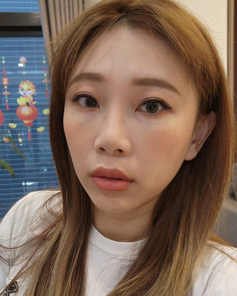 玻尿酸豐唇