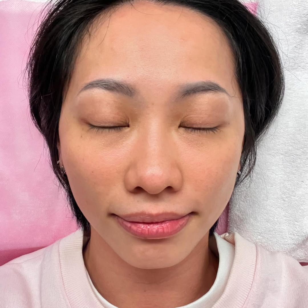 【杏仁酸煥膚】