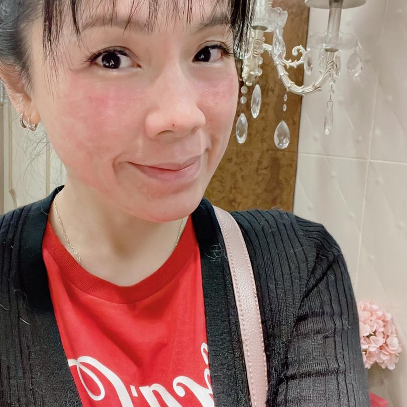 【雷射除毛】古亭星和診所-太令人驚喜的皮秒效果-花花的低醣世界sunny's LCHF world
